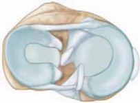 Illustration of meniscal repair meniscal repair - Dr. Mohammed Hutaif