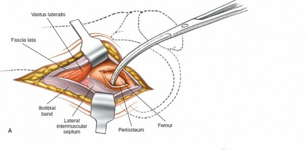Illustration 230 for Mastering Knee Approaches: Spotlight on Superficial Medial Ligament