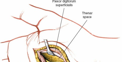Illustration 236 for Essential Surgical Approaches: Uncover Every Aspect of the Wrist