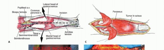 Illustration 5 for Soleus Resection for Tumors: Protecting the Heads of the Gastrocnemius