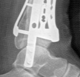 Illustration 29 for Decoding Pilon Fractures: Anterolateral and Medial Fragments Revealed