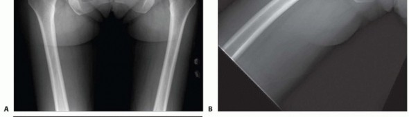 Illustration 3 for Anterior FAI Relief: Mini-Open Anterior Approach Explained