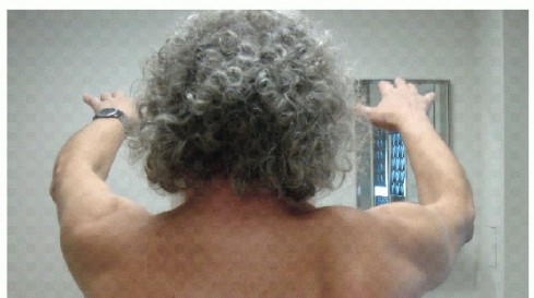 Regain Function: Pectoralis Major Transfer for Thoracic Nerve Palsy