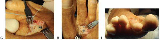 Illustration 43 for Plantar Plate Repair: End Lesser Toe Pain & Instability