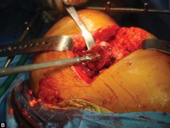 Illustration 43 for The Silent Hip: Achieving a Truly Silent, Pain-Free Joint