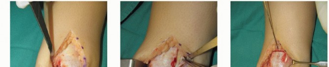 Unlock Healing: Medial Malleolar Osteotomy for Talus OLT Allografts