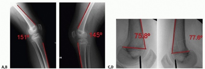 Illustration 13 for Optimizing Growth to Correct Pediatric Limb Deformities