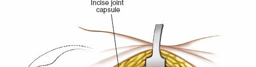 Illustration 19 for Acetabulum Posterior Approach: Simplest Fix for Hip Fractures