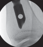 Illustration 49 for Optimal Nailing of the Tibia: Techniques for Challenging Fractures