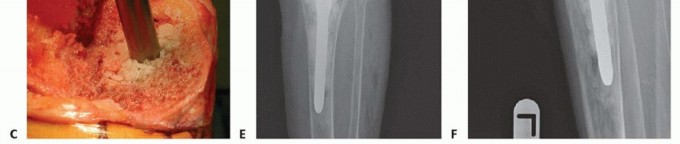 Illustration 6 for Bone Loss Bone Grafting for Challenging Tibial Defects