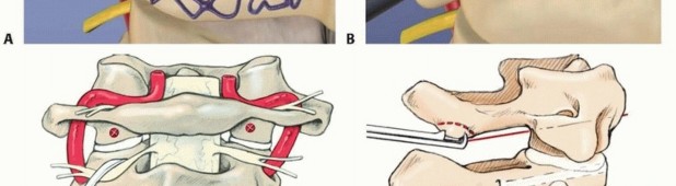 Illustration 11 for Addressing Cervical Spine Instability with Posterior Arthrodesis