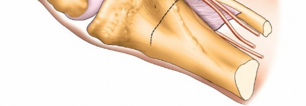 Figure 14: Temporary K-wire fixation after articular reduction.