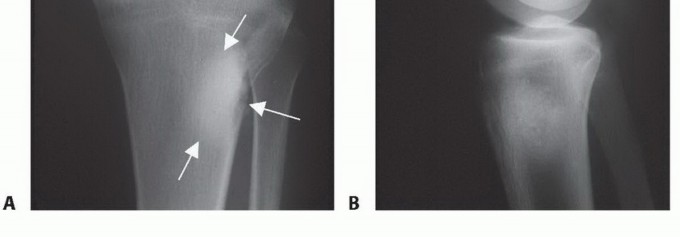 Illustration 2 for Tackling Complex Tumors of the Proximal Tibia: Limb-Sparing Solutions
