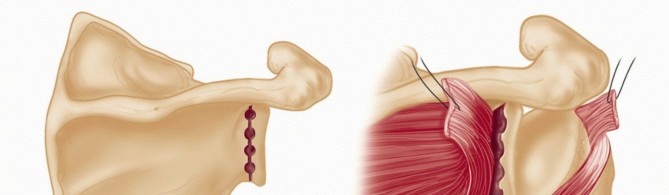 Illustration 30 for Mastering the Treatment of Recurrent Posterior Shoulder Instability