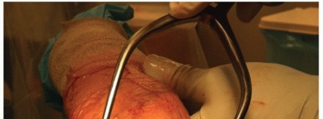 Illustration 43 for Surgical Approaches to Shoulder & Elbow: Pearls and Pitfalls