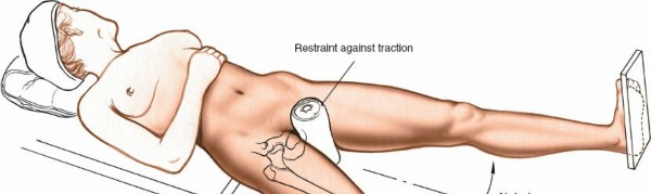 Illustration 2 for Optimal Femoral Approaches: Mastering the Lateral Intermuscular Septum