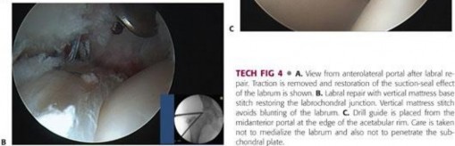 Illustration 117 for Precision Hip Arthroscopy: Unlock Access to the Peripheral Compartment