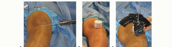 Illustration 3 for Solving Infantile Blount Disease: Surgical Management Strategies