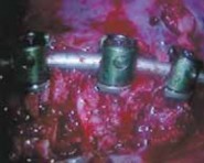 Illustration 27 for Mastering Anterior Interbody Arthrodesis with Instrumentation for Scoliosis