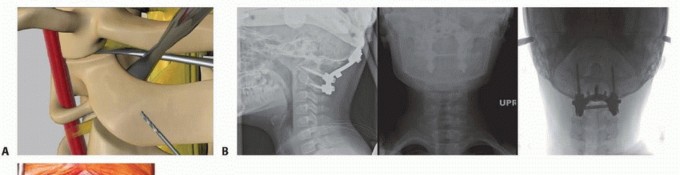 Illustration 14 for Addressing Cervical Spine Instability with Posterior Arthrodesis