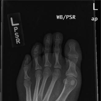 Illustration 2 for Foot & Ankle Cases: When to Consider a Strong Anterior Tibialis