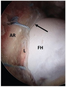 Illustration 28 for Beyond Knee Surg: Hip Arthroscopy for Sports Injuries