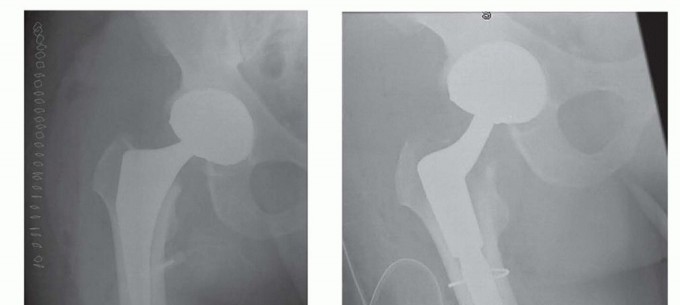Illustration 15 for Total Hip Arthroplasty: Journey to Preventing Complications
