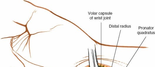 Illustration 23 for Volar Approach: Optimal Exposure for the Volar aspect of the Distal Radius