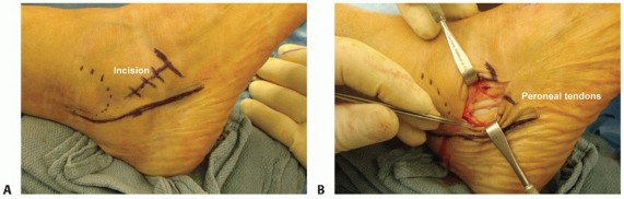 Illustration 9 for Lateral Column Lengthening: Relieve Flatfoot Pain & Correct Deformity