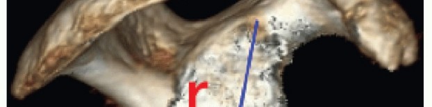 Illustration 7 for Glenoid Bone Graft for Anterior Shoulder Instability: Restore Stability