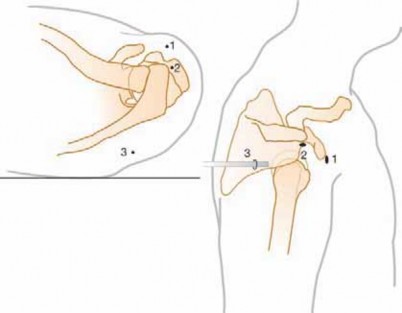 Illustration 10 for Arthroscopic Subscapularis Repair: The lo iky brady Method for Stability