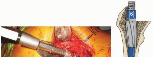 Illustration 16 for Recreate Hip Biomechanics: Modular Stems for Modular Solutions