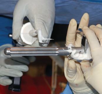 Illustration 58 for Mastering Gap Balancing in Revision TKA: Avoid Common Pitfalls