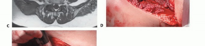 Illustration 40 for Pelvic Metastasis Surgery: A Component of the Utilitarian Approach