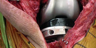 Illustration 43 for Hinged Total Knee: The Salvage Solution for Challenging Cases