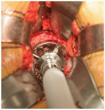 Illustration 5 for Mastering The Uncemented Socket: Ensure Lasting Hip Fixation