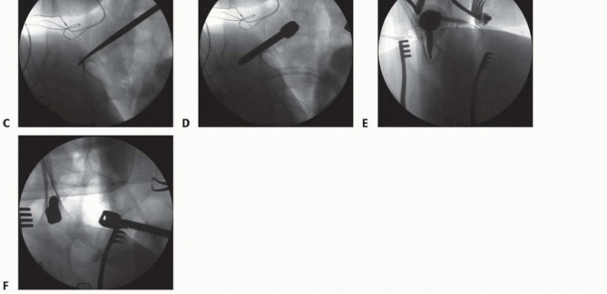 Illustration 14 for Duchenne Muscular Dystrophy: Is Spinal Fusion the Answer?