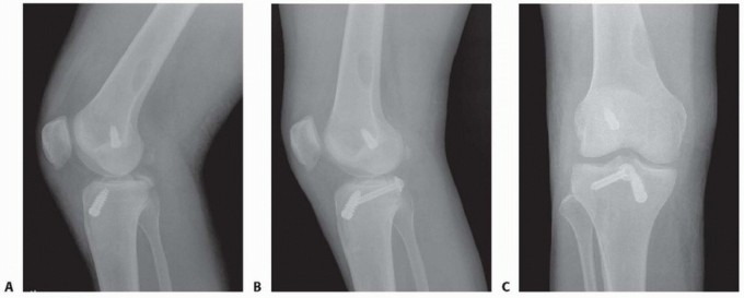 Illustration 26 for Posterior Cruciate Ligament Surgery: Regain Knee Strength & Stability
