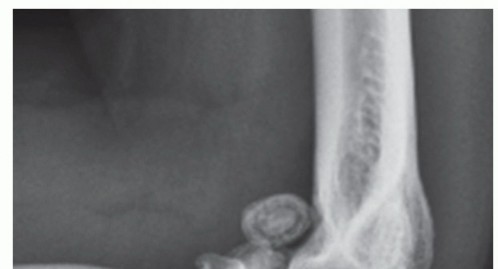 Illustration of arthroplasty for primary - Dr. Mohammed Hutaif