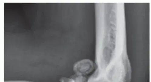 صورة توضيحية لـ وداعاً لألم خشونة الكوع: دليل المريض الشامل لعلاج واستبدال مفصل الكوع مع الأستاذ الدكتور محمد هطيف