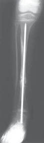 Illustration 21 for Solving Congenital Pseudarthrosis: Tibia with the Williams Rod