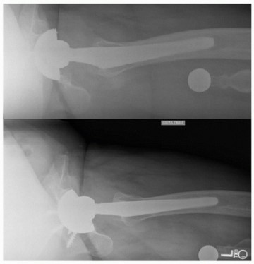 Illustration 11 for Mastering Revision THA: Strategies for Adverse Local Tissue Challenges