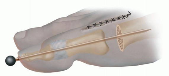 Illustration 19 for Hammer Toe Correction: Understanding the Extensor Digitorum Longus