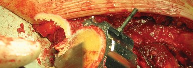 Illustration 45 for Figure Hip Resurfacing: Who Benefits and Who Should Avoid It?