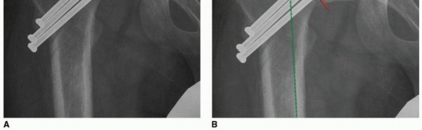 صورة طبية: جراحة قطع العظم حول الحُق وقطع عظم الفخذ: إعادة محاذاة مفصل الورك لراحة دائمة مع الأستاذ الدكتور محمد هطيف