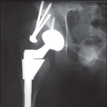 Illustration 122 for Successful Total Hip Replacement in Developmental Dysplasia