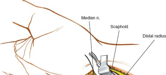 Illustration 25 for Volar Approach: Optimal Exposure for the Volar aspect of the Distal Radius