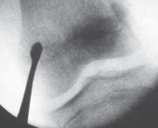 Illustration 7 for Percutaneous Epiphysiodesis: Precisely Closing the Third of the Physis
