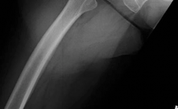 Illustration 4 for Primary Uncemented Total Hip Arthroplasty: A Case Study Title