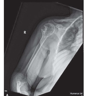 Mastering Orthopedics Oncology: Chondrosarcoma Cases